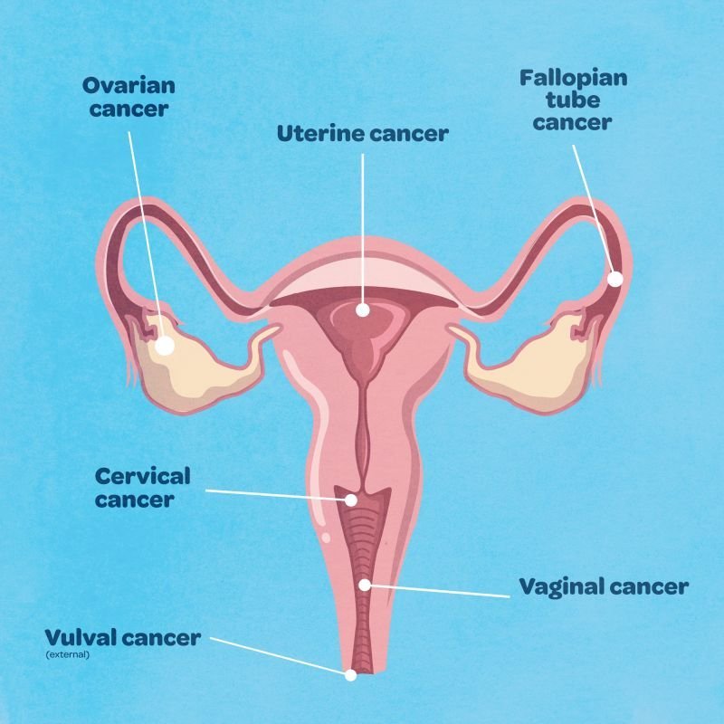 Ovarian Cancer: Causes, Symptoms, and Ayurvedic Management