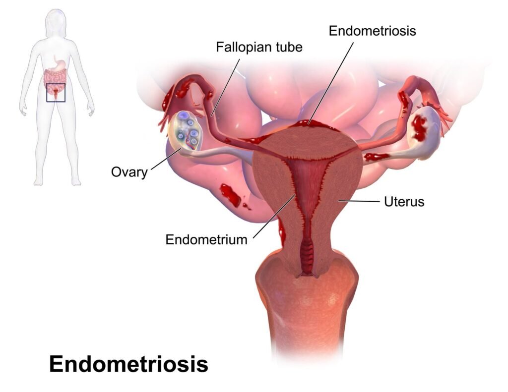 Endometriosis and ayurveda